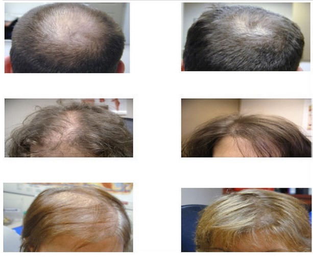 650nm Laser Hair Growth Machine Scalp Treatment Regrowth Salon Equipment
