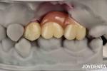 Customizable Dental Implant Supported Bridge And Crown For Dental Implants