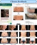FDA approved multifunction cool fat removal cavitation rf cryotherapy slimming