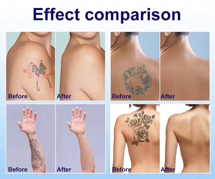 Most Sell Product 2 in 1 Picosecond Tattoo Removal Diode Hair Removal 755 808 1064 Nm Ice Hair Remove Machine