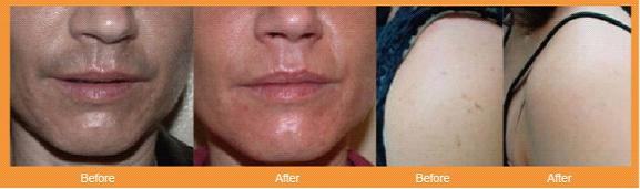 E-light IPL RF Permanent Hair Removal Beauty Equipment with RF Power 50w IPL Power 2500w