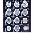 11in * 14in X-ray Dry Medical Imaging Films KND-A For AGFA 5300, 5302, 5500,