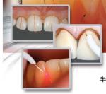 teeth whitening light/dental laser teeth white machine