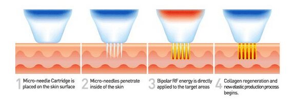 Nubway fractional rf microneedle face treatment machine