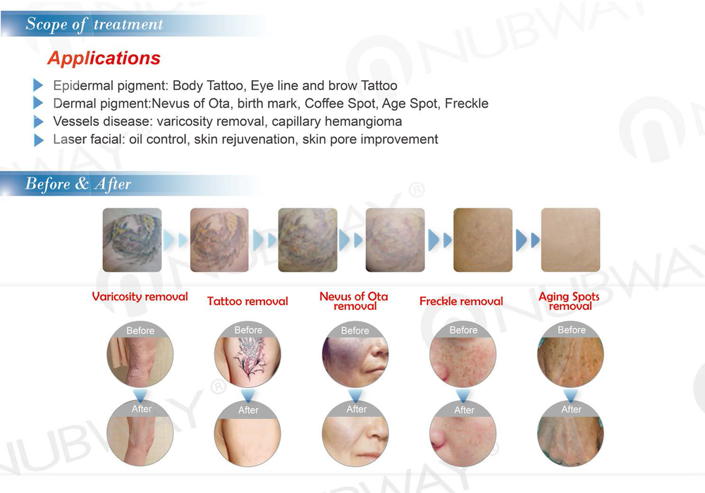1064nm 532nm Tattoo Removal Skin Tightening Q Switched Nd Yag Laser Machine