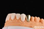 Wax Casted Gold 60K Metallic Dental Crowns Abrasive Resistant Gold Tooth Crown