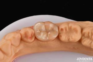 Wholesale High Durability Dental Inlay Onlay Composite Natural Looking Appearance from china suppliers