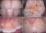 HK710 Intraoral Dental Camera