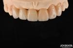 CAD / CAM Milling Dental Layered Zirconia For Single Crowns 0.3-0.5mm Layer