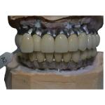 Corrosion Resistant Co Cr Implant Supported Metal Crown Biological Material
