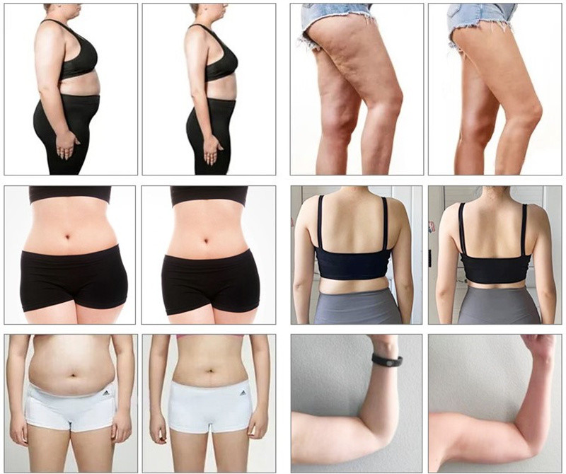 10d Emerald Maxlipo Master Laser Machine Fat Burning
