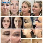 Treatment For Fine Lines Acne Treatment Nasolabial Folds Cervical Stripes