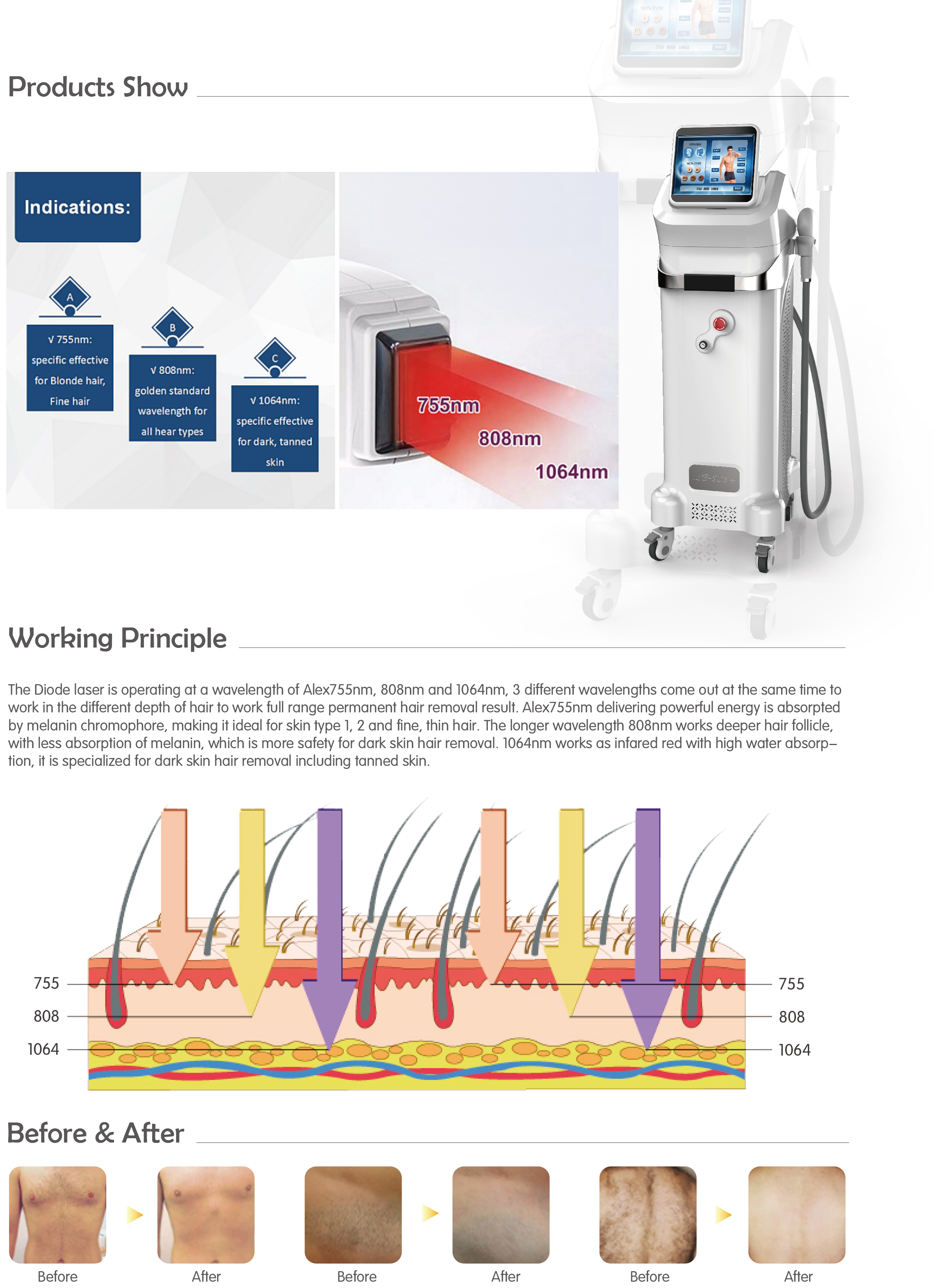 brazilian laser hair depalication 808,755&1064nm permanent hair removal for men