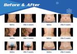 Factory price best selling cavitation rf vacuum cryolipolysis with 2 cryo handle
