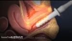 Non Surgical Therapy Vaginal Rejuvenation Radio Frequency For Clinical
