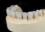 Natural Tooth Color Ceramic Feldspathic Veneer For Anterior And Posterior Teeth