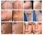 Vertical Professional Painless Lazer 808 nm Titanium Beauty Device Diode Laser