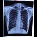 Medical X-ray Dry Film Medical X-ray Inkjet Film With Clear Image Quality