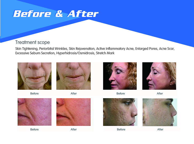 Nubway New Arrival!!! Fractional rf microneedle skin rejuvenation ce approved rf fractional micro needle machine