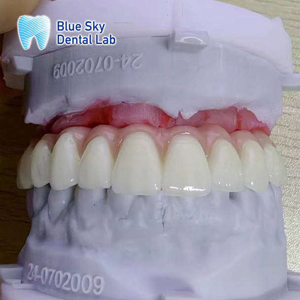 Universal Compatibility Implant Cases Customize Full Mouth Implant Case