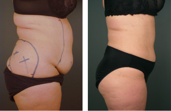 Aesthetic Surgical Liposuction Machine For Abdomen / Upper Arm Surgical Suction Slimming Machine