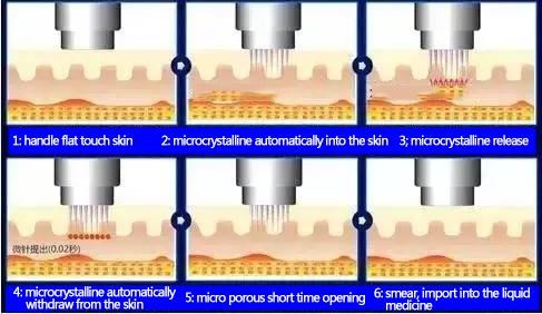 Fractional Microneedling Radio Frequency Machine for Pore Minimizing Skin Smoothing and Lifting