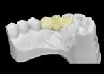 Chipping Resistance Zirconia dental Crown With Exceptional Strength And