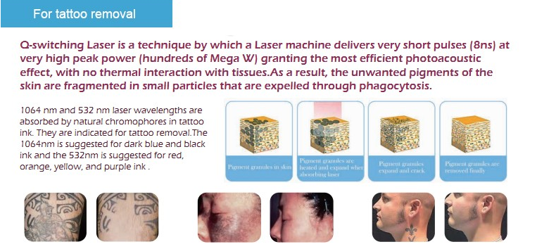 ruby laser q switch laser tattoo removal long pulsed nd yag laser