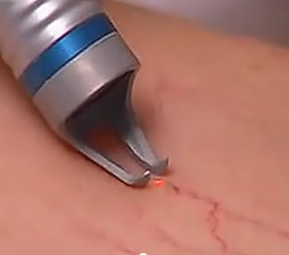 Varicose veins spider veins treatment machine Strong air cooling