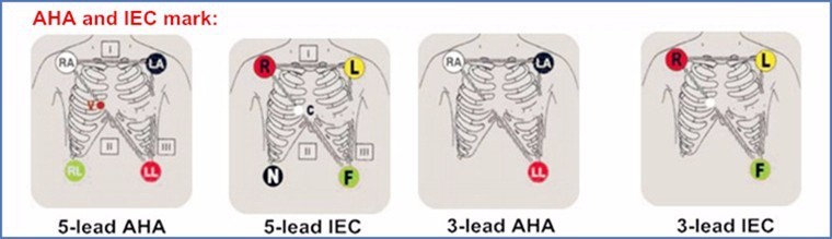 Disposable 5 Lead ECG Placement , ECG Lead Clips IEC / AHA Standard TP3010