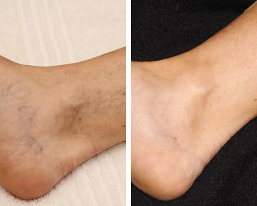 532nm 940nm Laser Machine For Spider Veins With Focus Handpiece