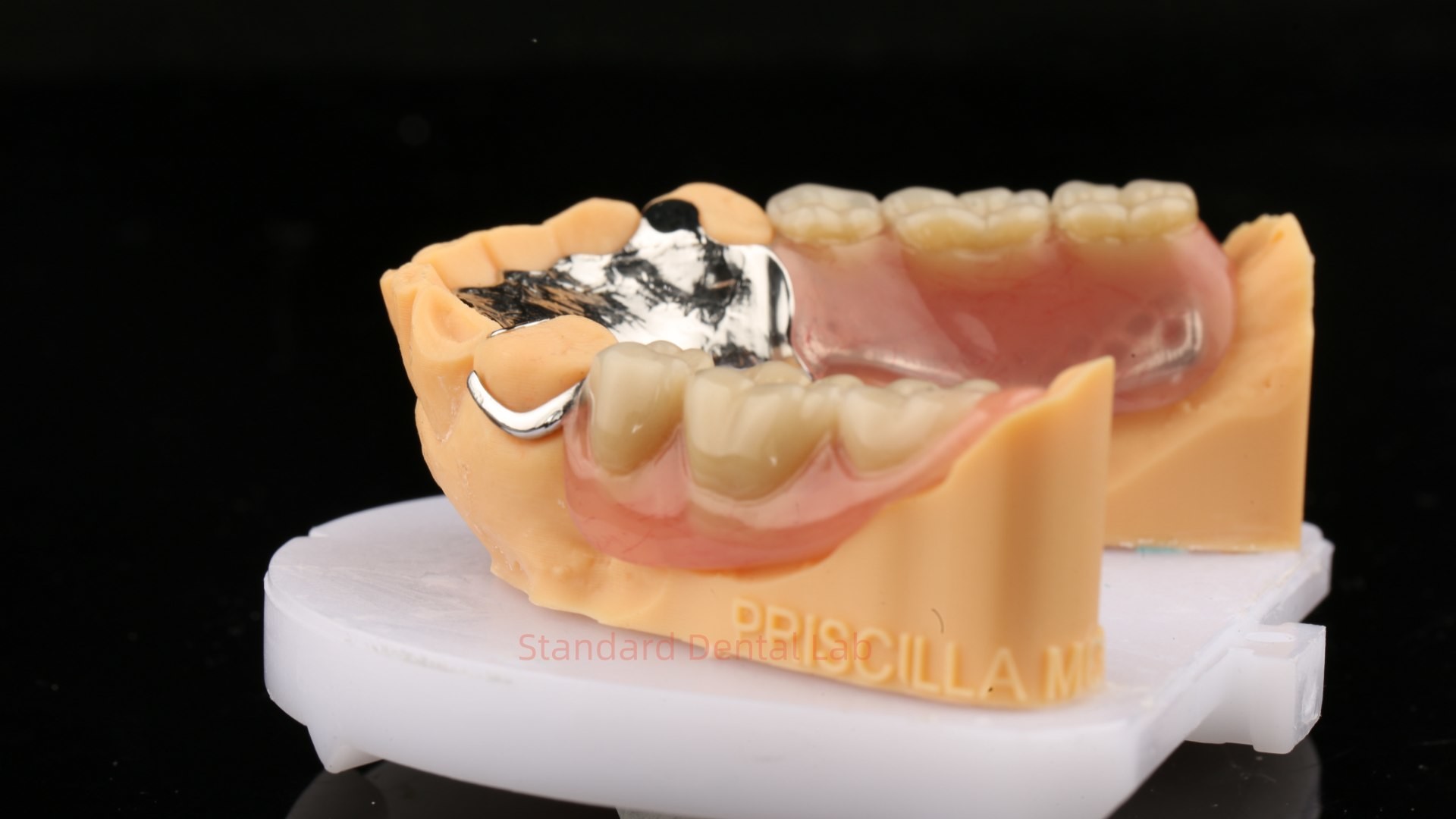 Metal Alloys Cobalt Chromium Partial Denture Ivoclar Scheftner Comfortable Cast Metal Framewrok