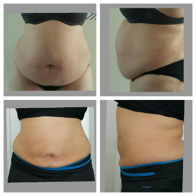 Comfortable Body Fat Freezing Machine , Weight Loss Portable Cryolipolysis Machine