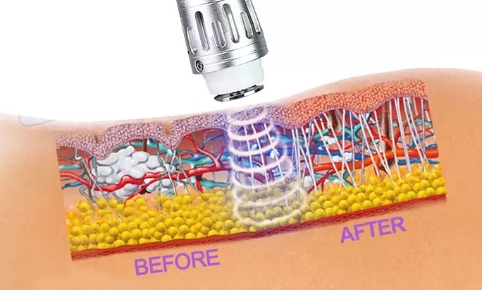 Low Intensity Shockwave Therapy Machine Erectile Dysfunction For ED Treatment