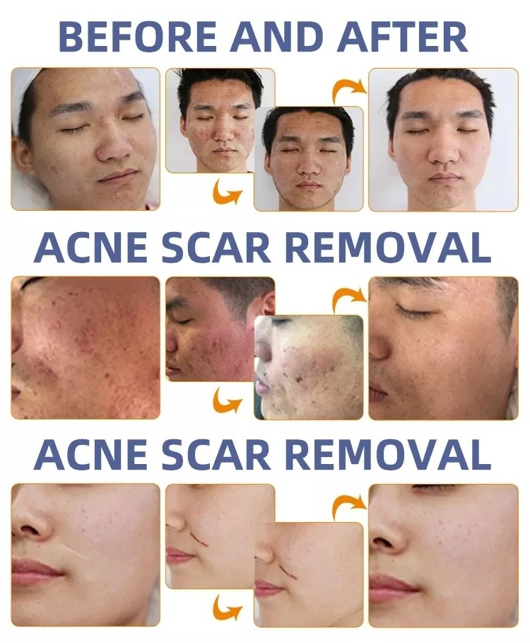 RF Fractional CO2 Laser For Stretch Marks Scar Removal Vaginal Tightening Machine
