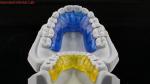 Comfortable Stainless Steel Acrylic Hawley Retainer Effective Orthodontics