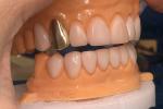 Wax Casted Gold 60K Metallic Dental Crowns Abrasive Resistant Gold Tooth Crown