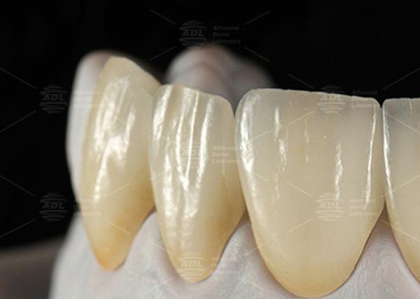 0.3mm-0.7mm Feldspathic EMAX Ceramic Veneers Natural Aesthetic Emax Dental