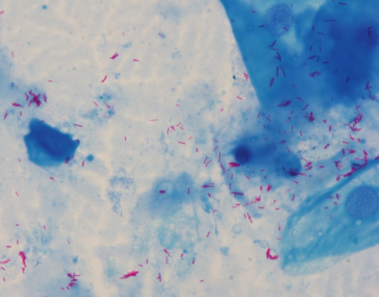 Rapid And Practical Acid Fast Stain Ziehl Neelsen Stain For Auto Stainer