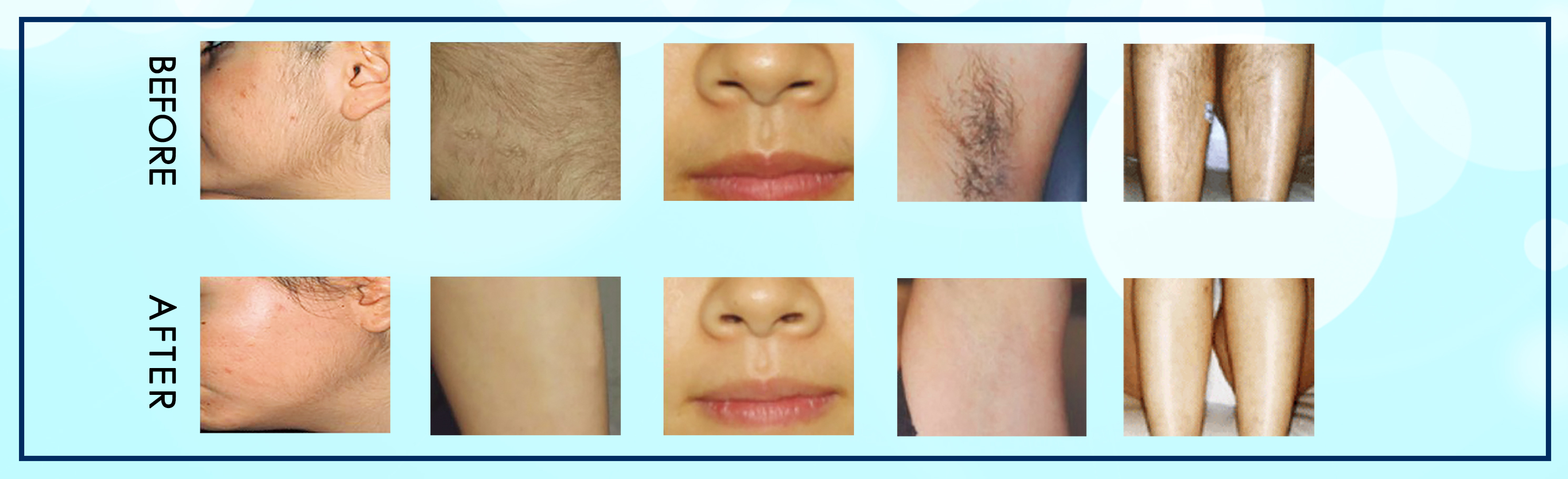600W Diode Laser 808nm Hair Removal Machine For Skin Tightening / Rejuvenation
