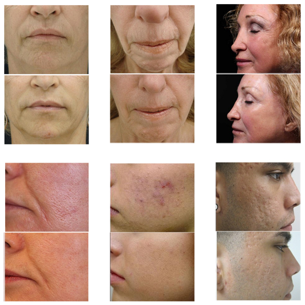 Wellness center Fractional RF Microneedle Acne Scar Removal Beauty Machine