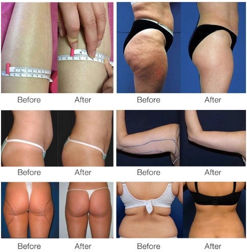 The most popular 40k ultrasonic cavitation lipo laser cavitation face rf beauty machine