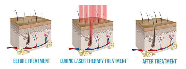 650nm / 670nm Real Diode Laser Machine Hair Growth Equipment With CE Approved