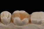E Max Material Inlay And Onlay In Dentistry Aesthetic Restoration Long Lasting