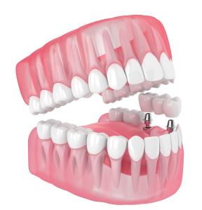 Wholesale Single All Ceramic Teeth Dental Implants Missing Filling Dentures Wisdom Teeth from china suppliers