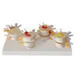 Vertebrae Diseased 4 Stage PVC Human Lumbar Spine Anatomy Model