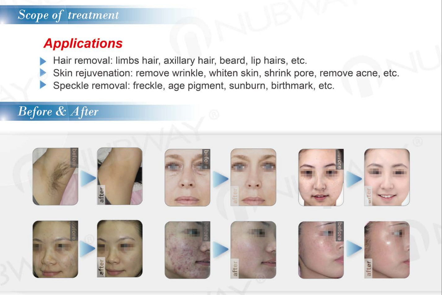 pigment removal ipl e-light rf shr shr ipl hair removal machine pain free