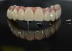 Zirconia Dental Crown: Natural-looking Teeth, Durable & Secure