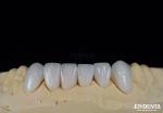 Long-lasting And Stain Resistant Dental Veneers With Personalized Shades For