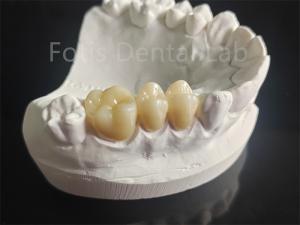 Wholesale Wear Resistance Zirconia Layered With Porcelain Dental Material from china suppliers